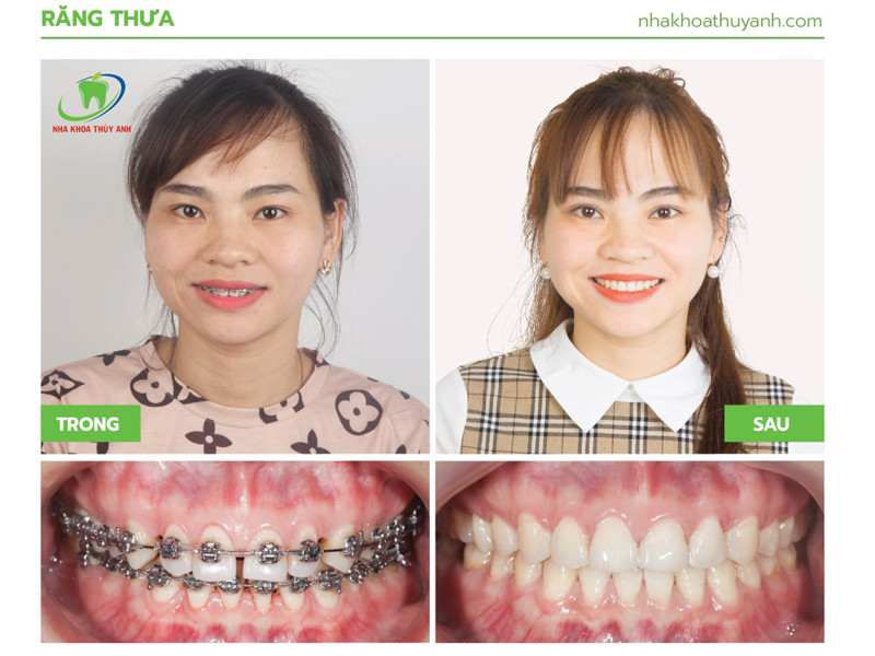 Răng thưa và những phương pháp điều trị hiệu quả Thái Nguyên