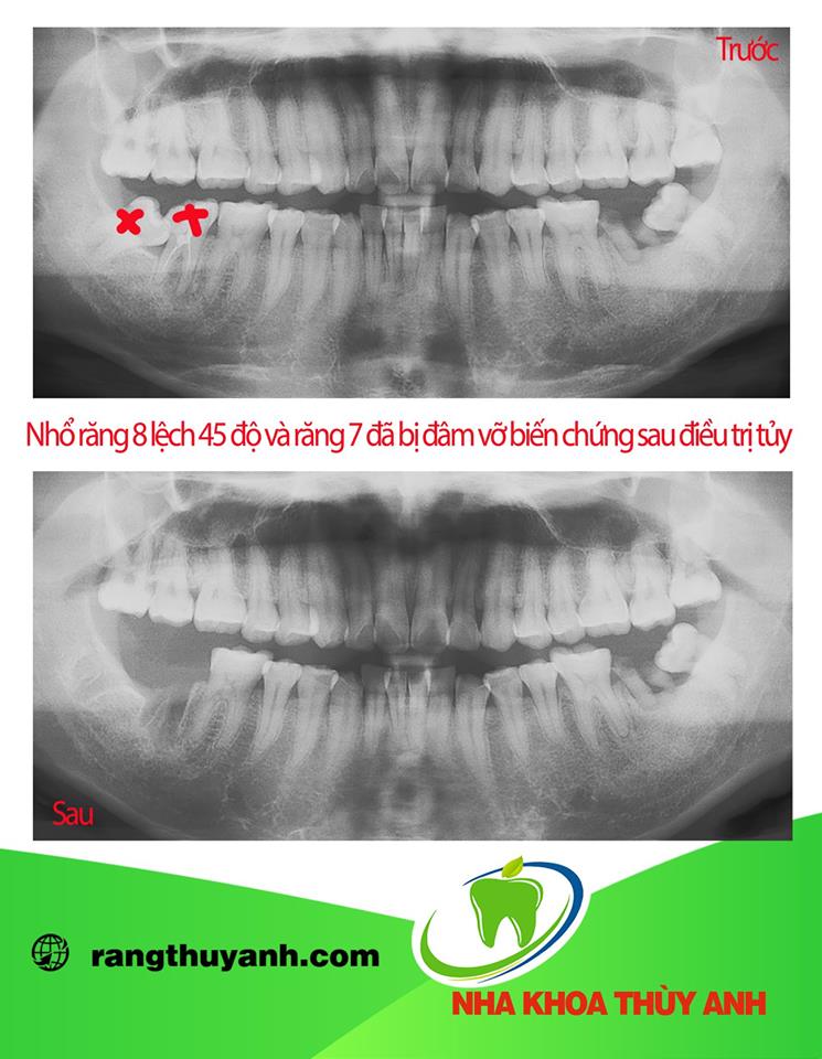 5  Nguy cơ biến chứng nguy hiểm của răng khôn mọc lệch 90 độ Xử lý răng khôn mọc lệch ngay tại Thái Nguyên.