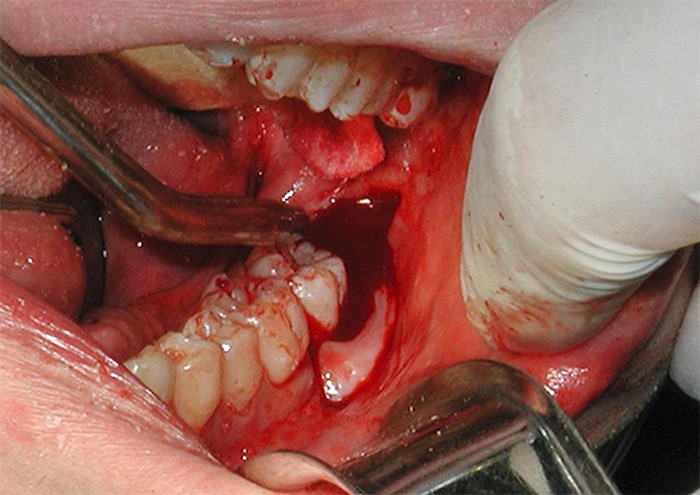 Lời dặn bác sỹ dành cho bệnh nhân sau khi nhổ răng.