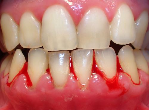 Hậu quả của vệ sinh răng miệng không đúng cách Những lời khuyên của bác sĩ tại Nha Khoa Thùy Anh Thái Nguyên.