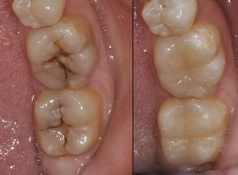 Hàn răng không đau tại Nha Khoa Thùy Anh Thái Nguyên