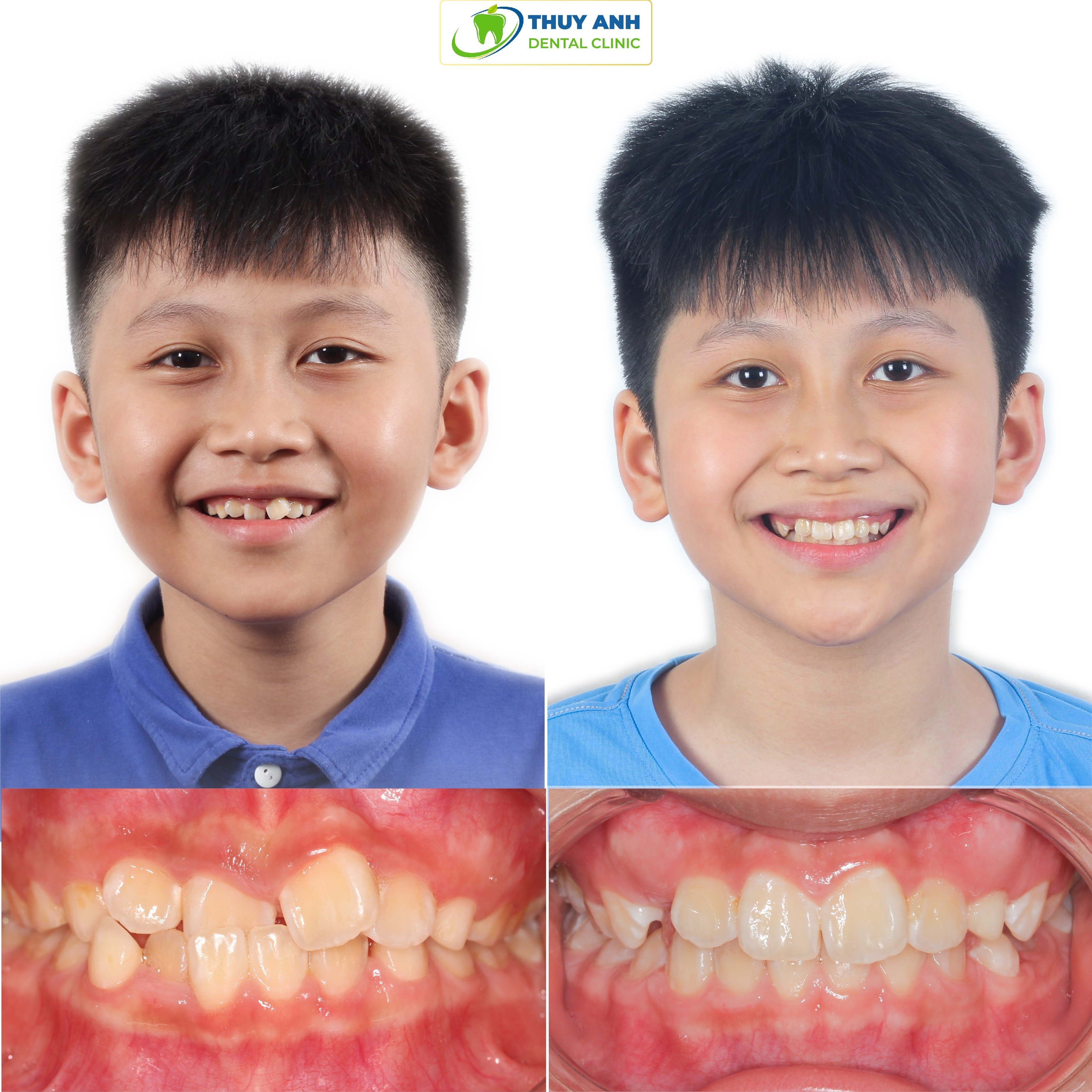 Niềng răng máng trong suốt invisalign có phải nhổ răng không?