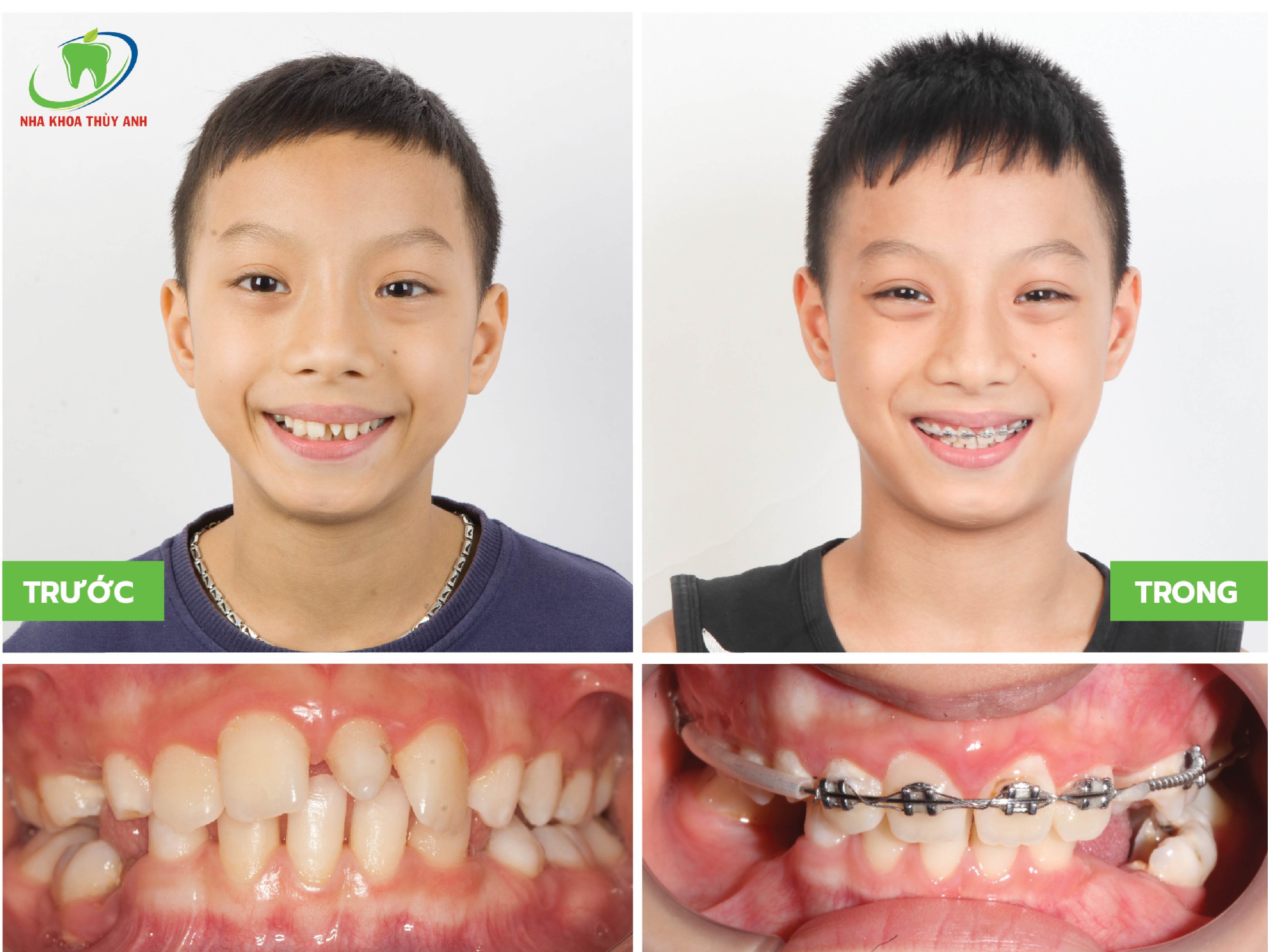 Niềng răng cho trẻ giá bao nhiêu? Niềng ở đâu Thái Nguyên thì tốt?