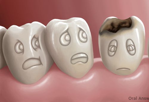 Bị sâu răng có niềng răng được hay không? Nha Khoa Thùy Anh Thái Nguyên