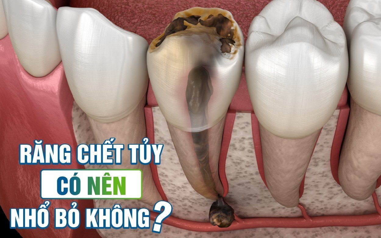 Răng chết tủy là gì, có nên nhổ bỏ không? Nha Khoa Thùy Anh Thái Nguyên 