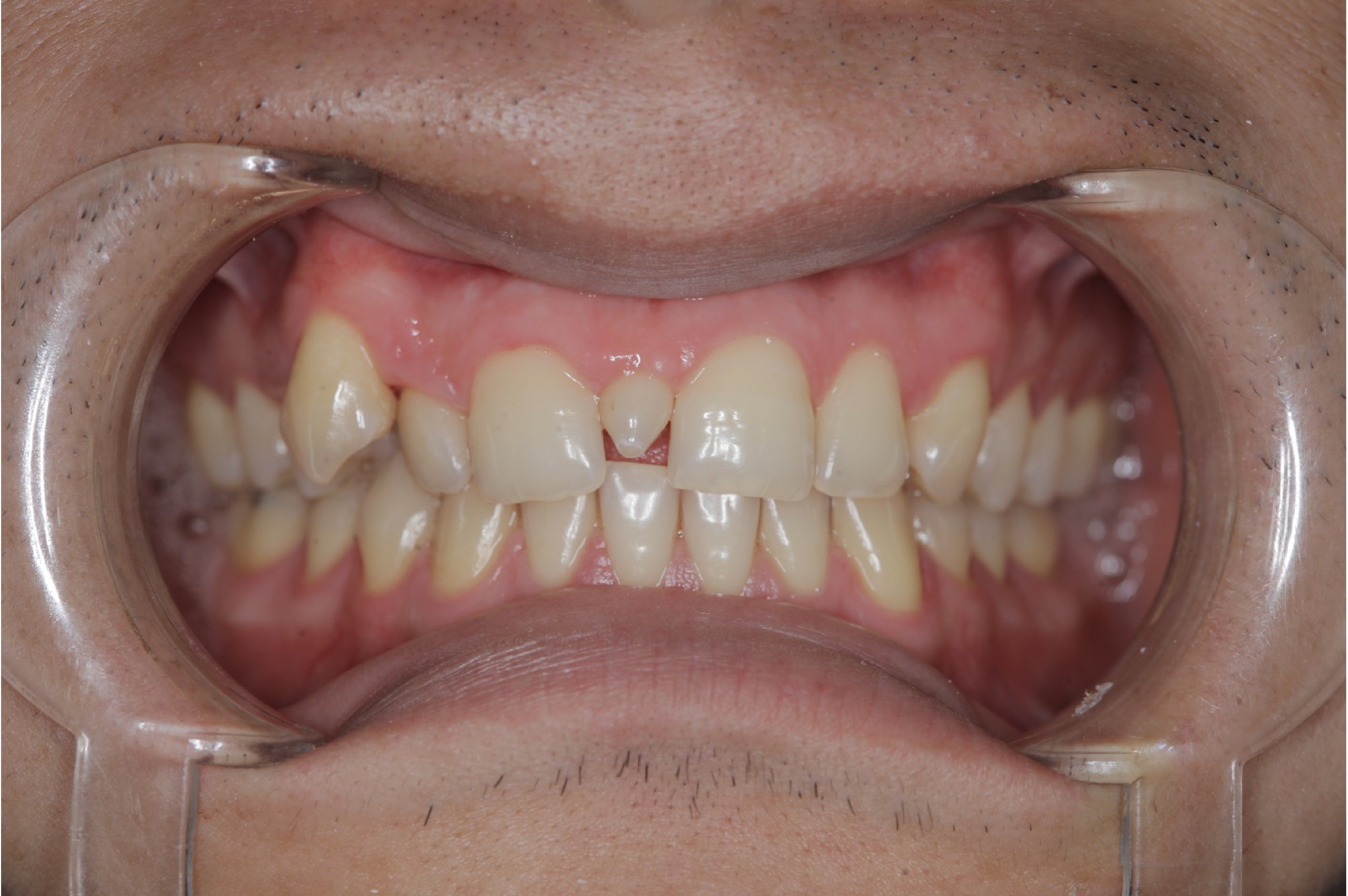 Răng kẹ thừa giữa 2 răng cửa và phương pháp điều trị hiệu quả