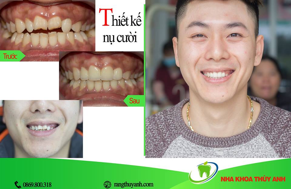 Nên chọn Niềng Răng hay làm răng Sứ? Khi nào nên niềng răng?