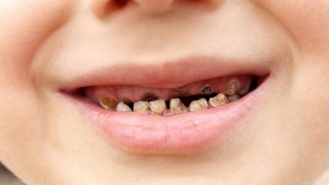 Điều trị sún răng sớm cho trẻ – Nha Khoa Thùy Anh Thái Nguyên