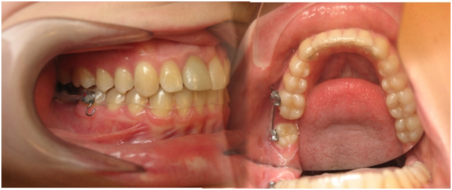 Mất răng có niềng răng được không? Nên trồng răng hay kéo răng thay thế răng mất Nha Khoa Thùy Anh Thái Nguyên