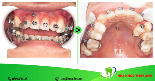 Nâng khớp trong niềng răng là gì? có tác dụng gì và mất bao lâu?