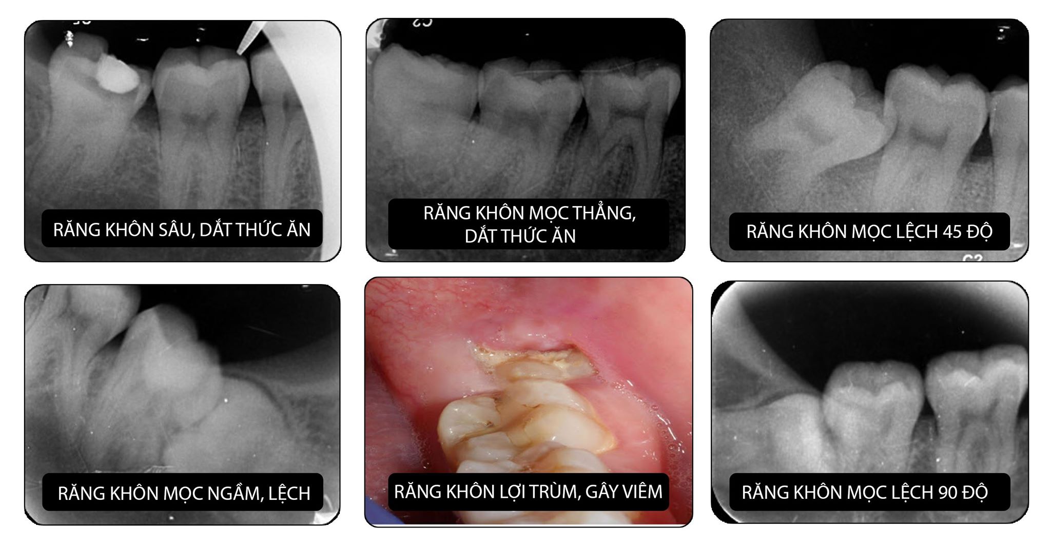 Vi Sao Phải Chụp Xquang Trước Khi Nhổ Răng Khon