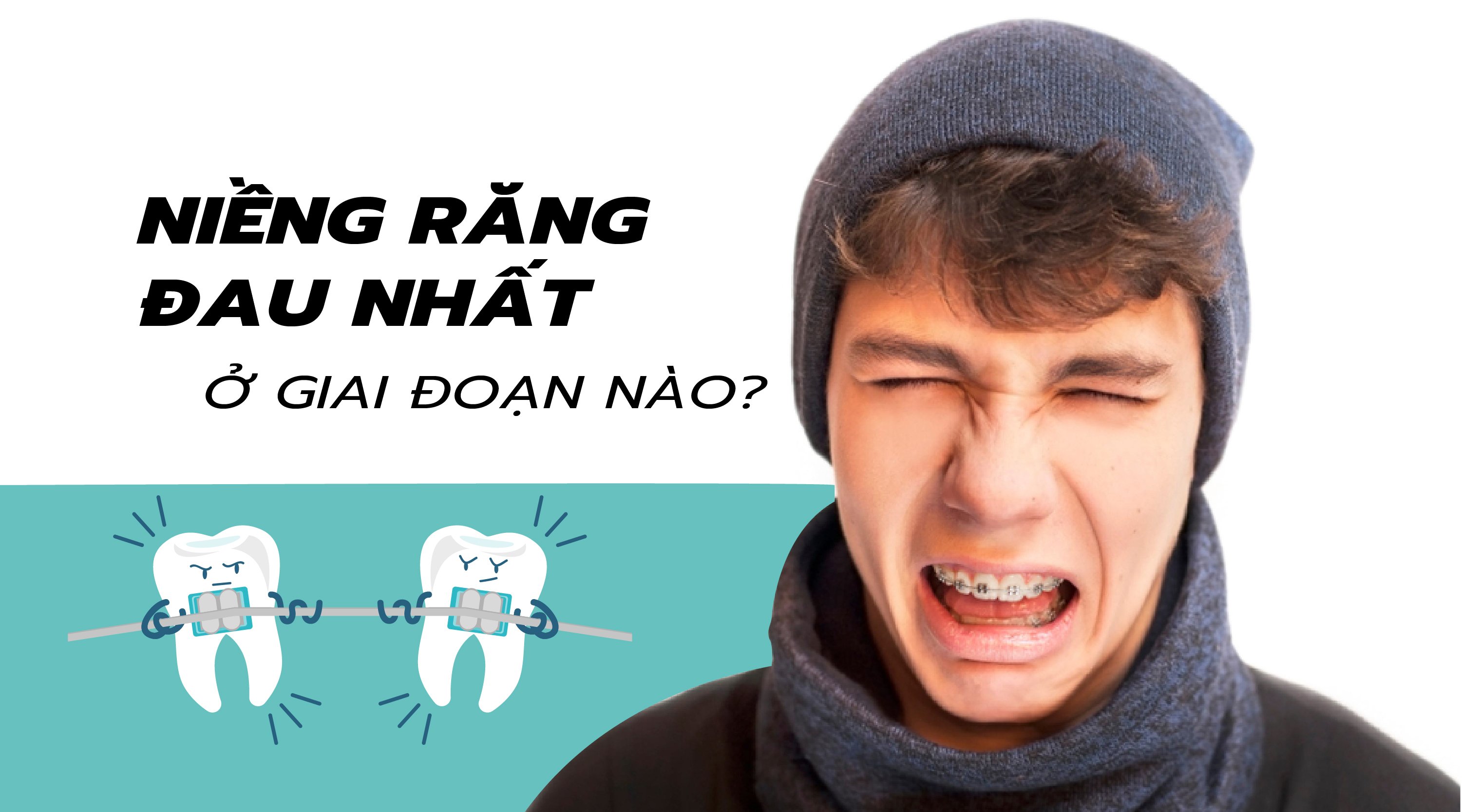 Niềng răng đau nhất ở giai đoạn nào Thái Nguyên?