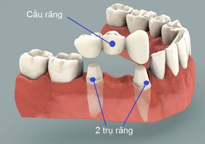 Những Biến Chứng Có Thể Xảy Ra Sau Khi Nhổ Răng