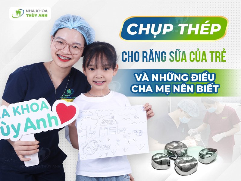 Chụp thép cho răng sữa của trẻ và những điều cha mẹ nên biết.